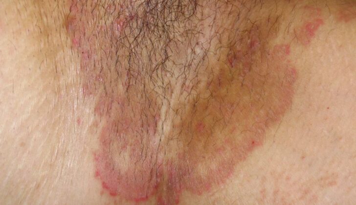 Tinea Cruris