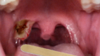 Tonsillar mass