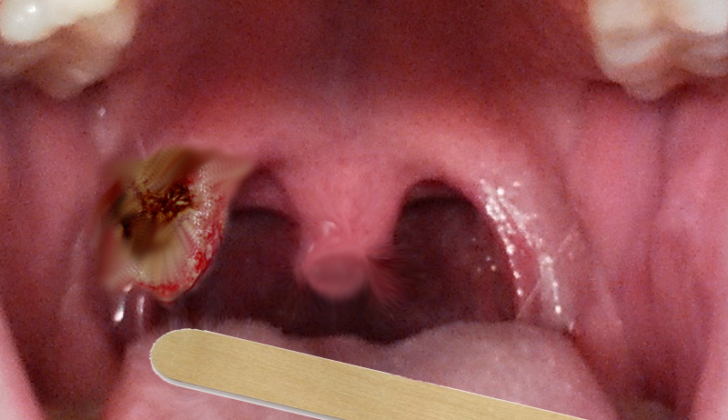 Tonsillar mass