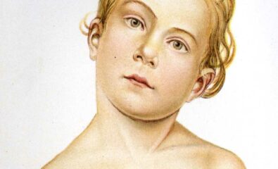 Child with Torticollis. An illustration of findings of a child with untreated torticollis.