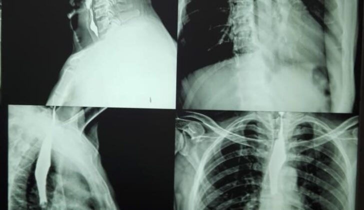 Esophageal Radiography With Contrast. These images show complete esophageal stricture as a complication of caustic ingestion.