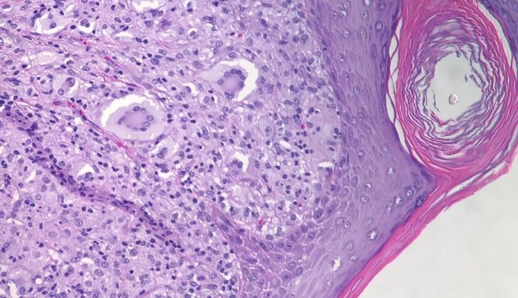 Juvenile Xanthogranuloma