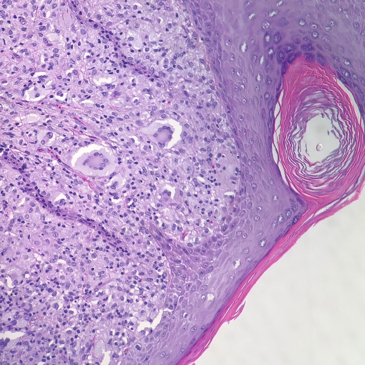 Juvenile Xanthogranuloma - MD Searchlight, image size:1280x1280