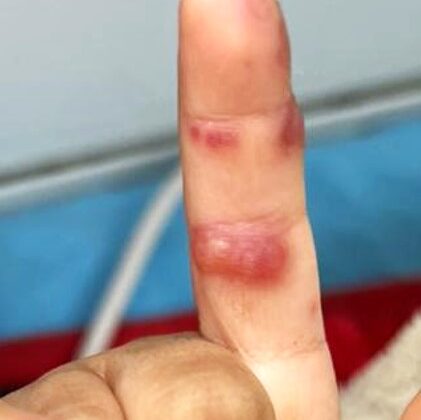 Blistering Dactylitis. Multiple bullae over the index finger.