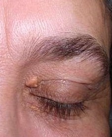 Xanthelasma palpebrarum. Yellowish deposits over the left upper and lower eyelid.