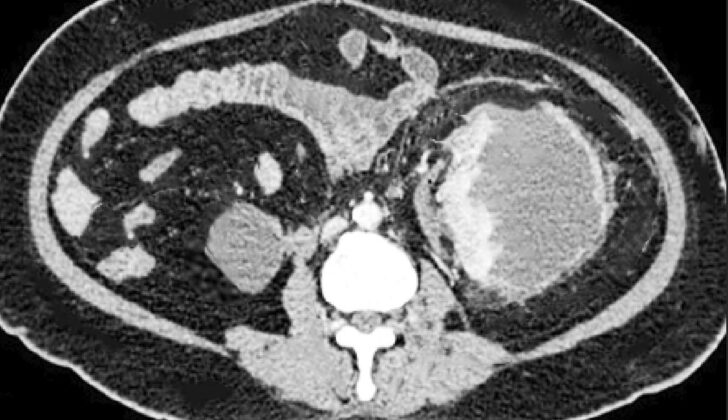 Page Kidney. This image of a CT scan reveals Page kidney.