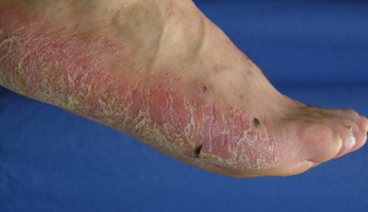 Palmoplantar Psoriasis