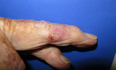 Intraepidermal Carcinoma