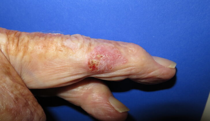 Intraepidermal Carcinoma