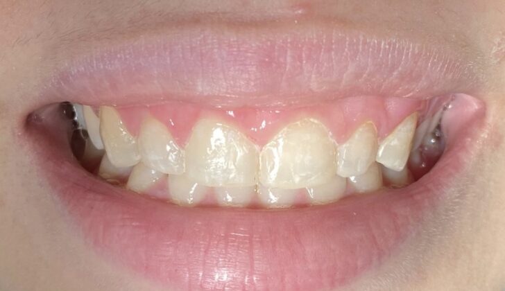 Excessive gingival display