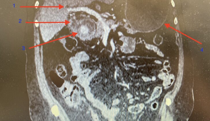 Bouveret Syndrome With Rigler Triad. Initial computed tomography of the abdomen revealed typical Bouveret syndrome with Rigler triad. (1) pneumobilia, (2) collapse of the gallbladder, (3) ectopic gallstone in the proximal duodenum, size more than 4 cm, (4) distended stomach.