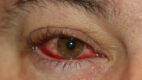 Blepharoconjunctivitis with inflammation of the eyelid margin and conjunctiva