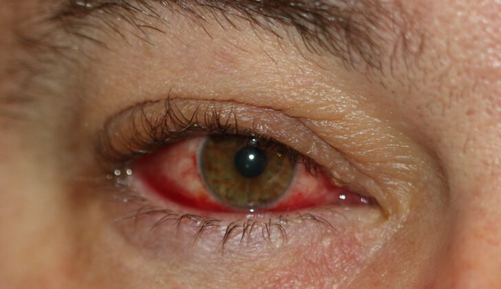 Blepharoconjunctivitis with inflammation of the eyelid margin and conjunctiva