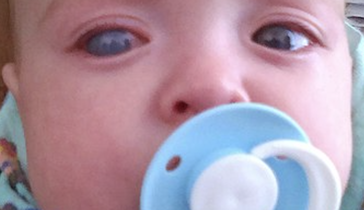 Example of buphthalmos of the right eye in an infant.
