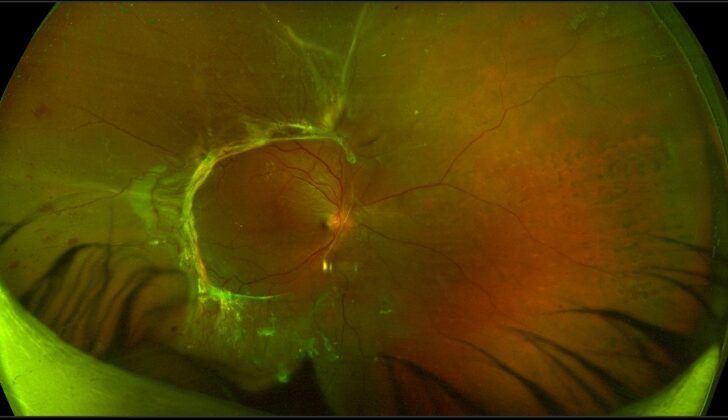 Proliferative diabetic retinopathy with extramacular tractional retinal detachment