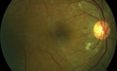 Cotton Wool Spots. Cotton wool spots were observed in a patient taking interferon during a funduscopic examination.