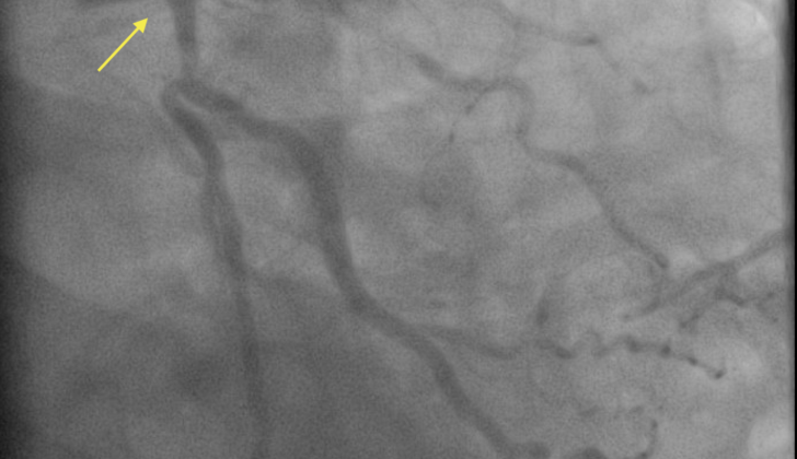 Coronary angiogram showing severe left main coronary artery disease with a bifurcation lesion involving the ostial left anterior descending artery and the ostial left circumflex artery.