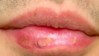 Actinic cheilitis