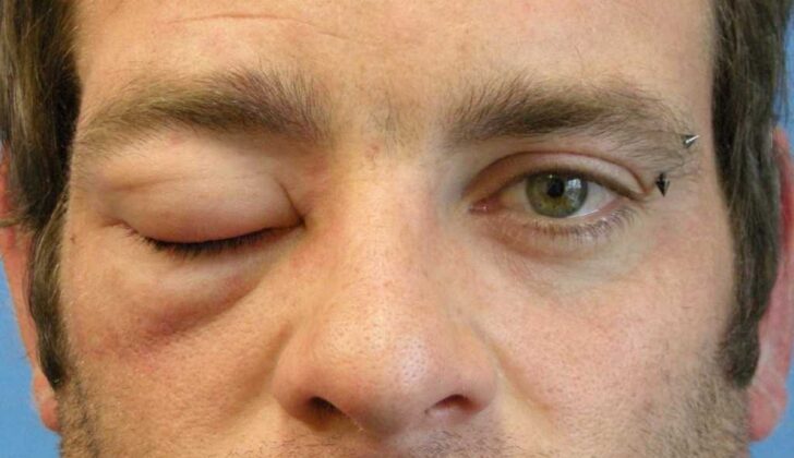 Angioedema