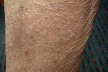 Xerosis Cutis