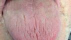 Xerostomia. This is an image of a patient with xerostomia (dry mouth). Note the fissures on the dorsum of the tongue.