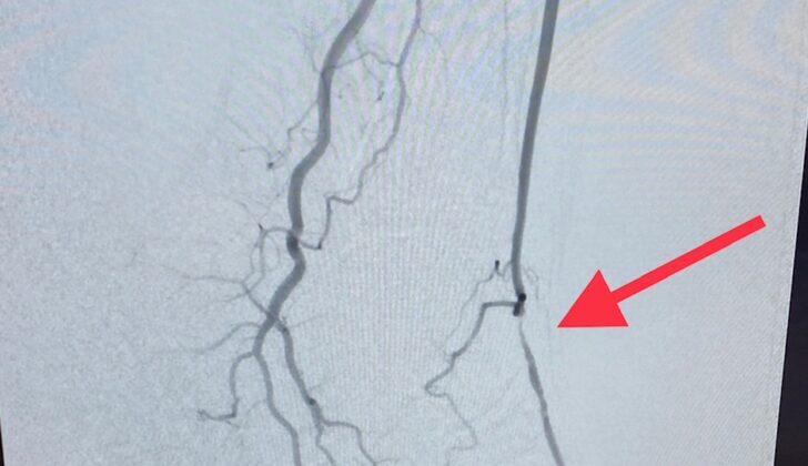 Peripheral Arterial Disease - High Grade Stenosis of Dorsalis Pedis Artery of the foot.