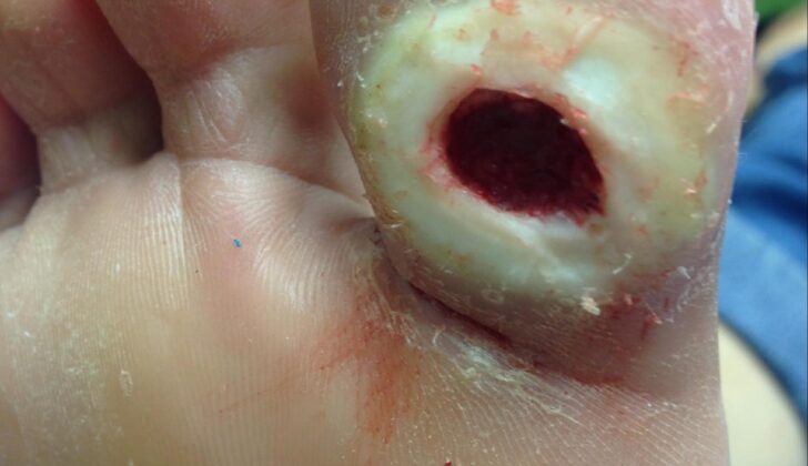Diabetic Foot Ulcer. Neuropathic ulceration in a patient with diabetes. Note periwound callous formation. Wagner Grade 2.