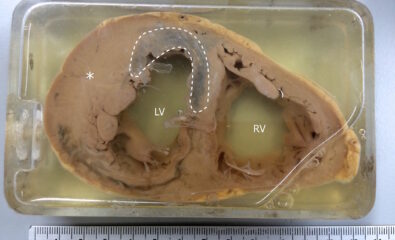 Specimen Showing Myocardial Infarction. MI is observed in the left ventricle and the interventricular septum. The asterisk(*) indicates left ventricular hypertrophy.