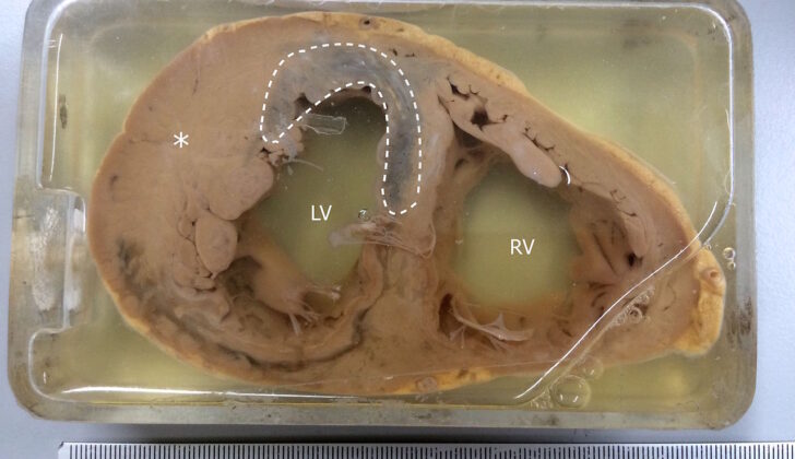 Specimen Showing Myocardial Infarction. MI is observed in the left ventricle and the interventricular septum. The asterisk(*) indicates left ventricular hypertrophy.