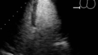 Mid-Ventricular Cardiomyopathy. The picture shows the Left Ventricle in Diastole.