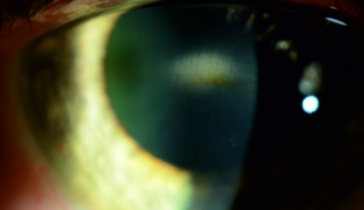 Example of corneal opacity in keratoendotheliitis fugax hereditaria.