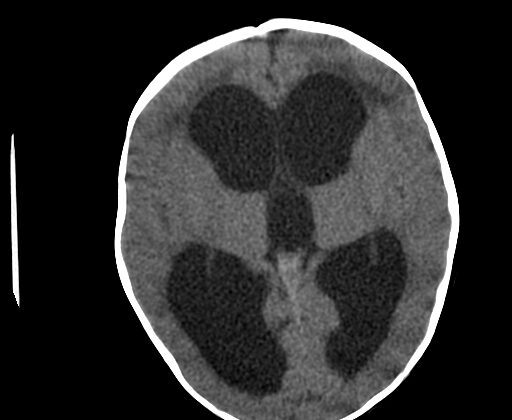 Head CT, Hydrocephalus