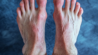 Redness of feet