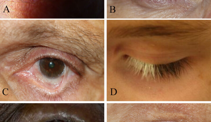 Eye Disorders and Trachoma-Associated Symptoms. Trichiasis. The eyelid itself is not turning in, but the lashes are pointing inward (A). Madarosis. Short stubby lashes of different sizes indicate trichotillomania (B). Symblepharon with secondary trichiasis, fornix shortening, and cicatricial entropion (C). Poliosis (D). Trachoma with corneal opacification (E). Pemphigoid disease with cicatricial entropion, trichiasis, ankyloblepharon, corneal scarring, and dry eyes (F).