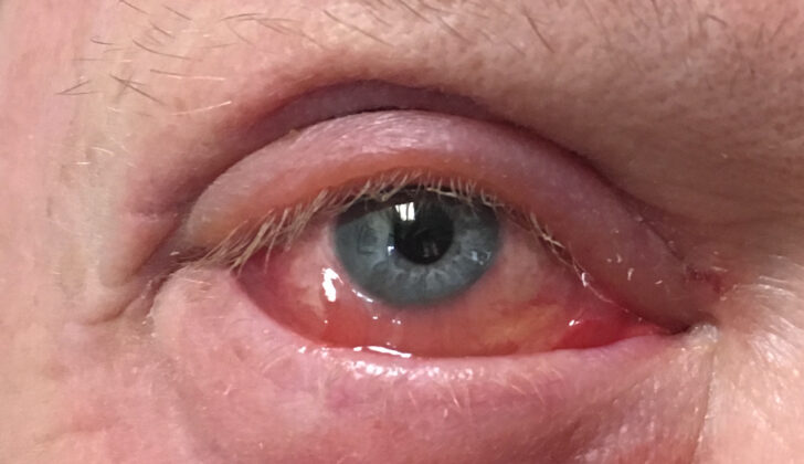 Chemosis. Conjunctival edema and inflammation can be seen with viral and bacterial infections after eyelid surgery, trauma, thyroid disease, and orbital tumors.