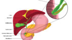 Illustration of Bile Duct Stricture. Illustration of the bile duct stricture, including the liver, stomach, gallbladder, cystic duct, common bile duct, pancreatic duct, duodenum, and pancreas.