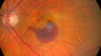 Age-Related Macular Degeneration on Funduscopy. This fundus photo of a left eye demonstrates drusen with a submacular hemorrhage, a complication of wet (exudative or neovascular) age-related macular degeneration.