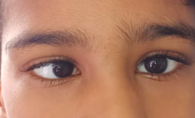 Digital image depicting a case of acute onset esotropia