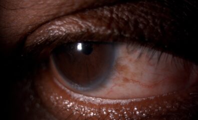 Lower Eyelid Frothing. A digital slit-lamp image of the patient depicting frothing on the lower eyelid margin suggests meibomian gland disease.