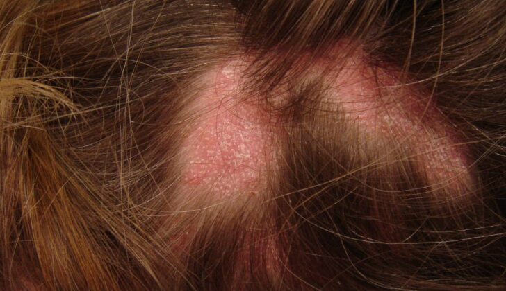 Lichen Planopilaris. Classic lichen planopilaris is a chronic inflammatory condition leading to patchy, progressive cicatricial alopecia, most commonly on the scalp. Frontal fibrosing alopecia presents as band-like cicatricial alopecia in the frontal and temporal zones of the scalp.