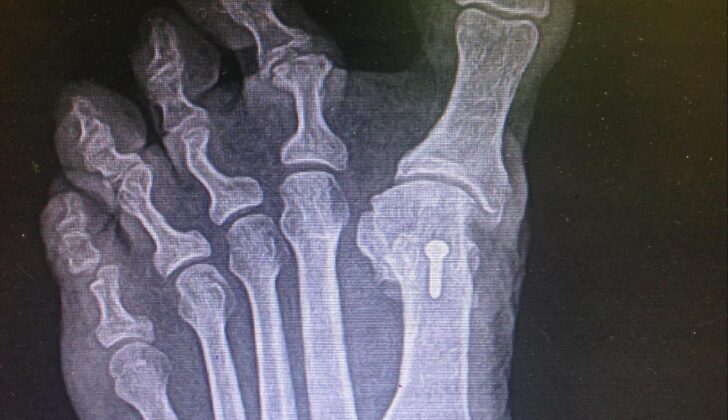 Iatrogenic Hallux Varus. Hallux varus or abduction in the transverse plane secondary to surgical overcorrection of hallux valgus (bunion).