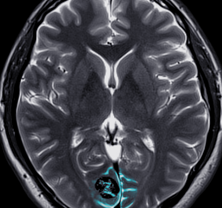 Cerebral cavernous hemangioma