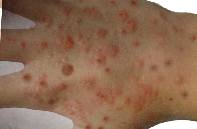 Hydroa-vacciniforme