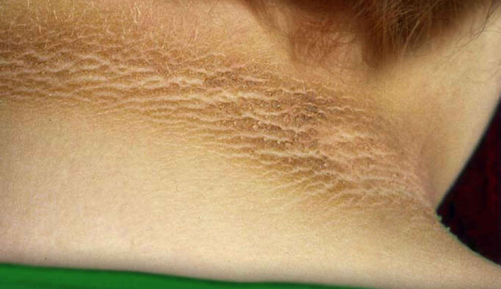 Acanthosis Nigricans