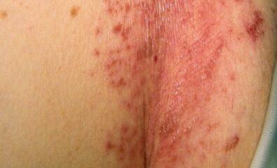 Candida Intertrigo