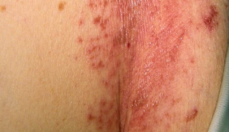 Candida Intertrigo