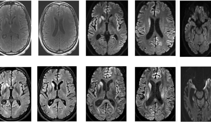 Brain MRI of a Patient With Early-Stage Creutzfeldt-Jakob Disease. Top: April 2016. Bottom: May 2016. Asymmetric T2, fluid-attenuation inversion recovery, and diffusion-weighted hyperintensities in the putamen and caudate. Frontal and temporal cortical regions of restricted diffusion are clearly visible.