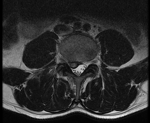 Lumbar Spine Disc Herniation, Magnetic Resonance Image. In the lumbar spine, a herniated disc can present with symptoms, including sensory and motor abnormalities limited to a specific myotome.