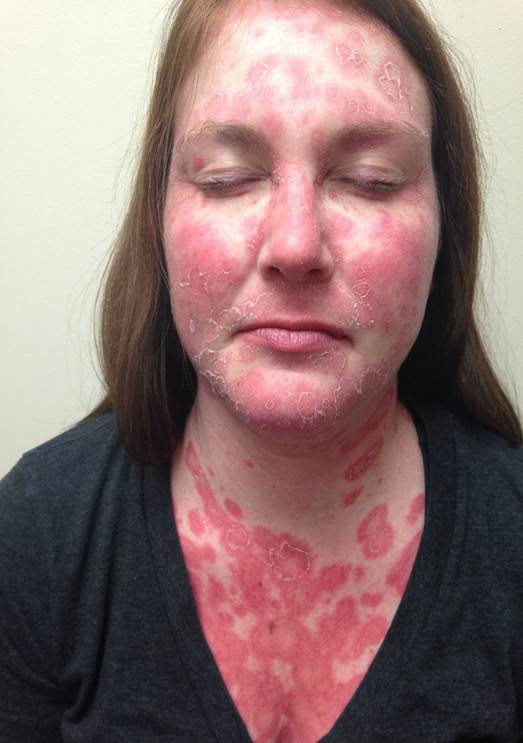 Subacute Cutaneous Lupus Erythematosus Face and Neck Lesions. Multiple
papulosquamous and annular polycyclic lesions of subacute cutaneous lupus
erythematosus (SCLE).