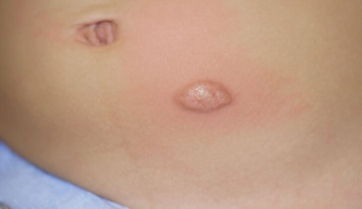Mastocytoma